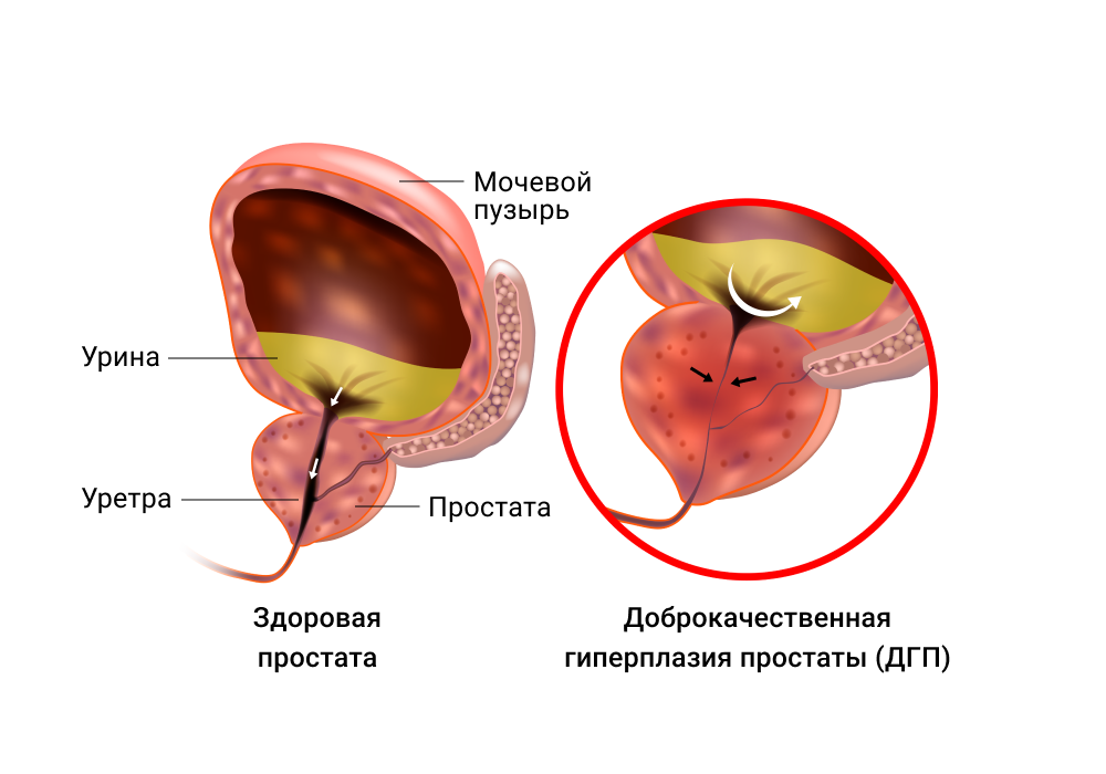 здоровая простата и аденома простаты иллюстрация