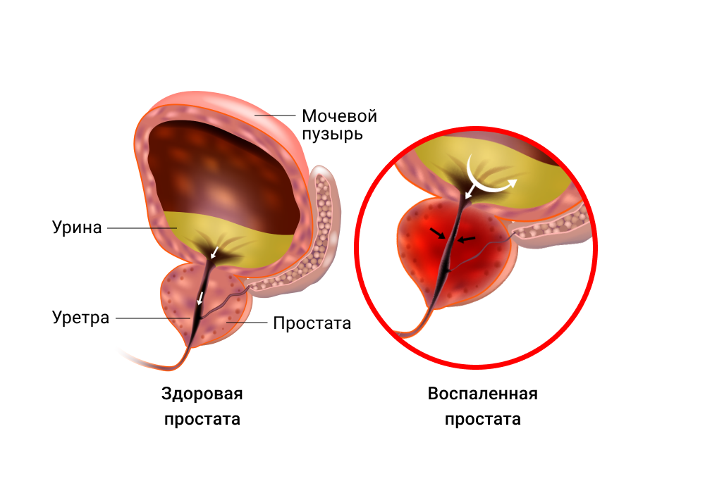 здоровая простата и простатит (воспаление простаты) иллюстрация