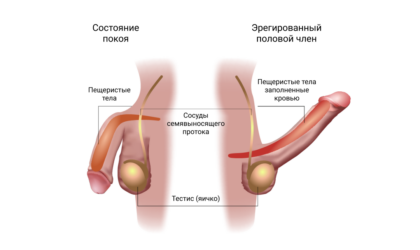 приапизм (состояние болезненной эрекции) схема